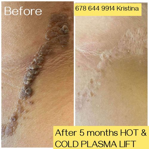 Kết quả hot cold plasma lift sau 5 tháng