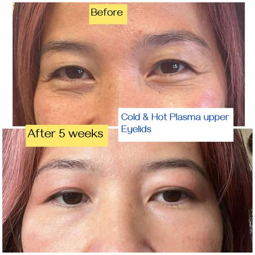 Kết quả cold hot plasma mí trên sau 5 tuần