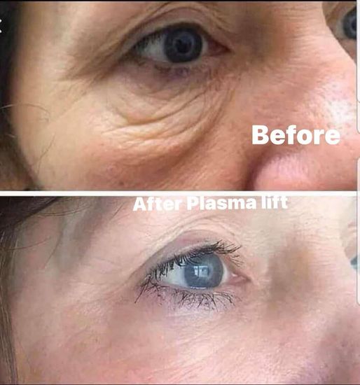 Kết quả plasma lift vùng mắt