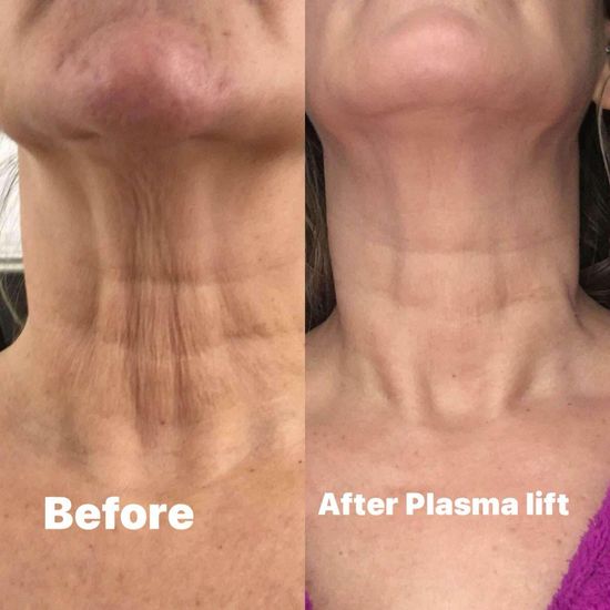 Kết quả plasma lift vùng cổ