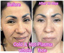 Kết quả cold plasma sau 10 ngày