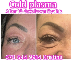Kết quả cold plasma mí dưới sau 10 ngày